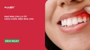 Minh họa nạo nha chu là gì và cách chữa viêm nha chu