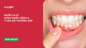 Minh họa nướu là gì và vấn đề của nướu