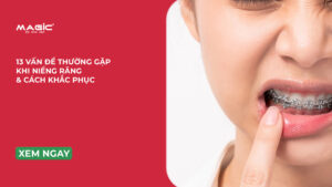 Minh họa các vấn đề khi niềng răng