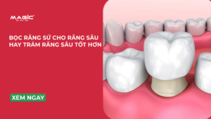 Minh họa bọc răng sứ cho răng sau hay trám răng sâu