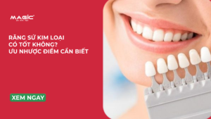 Minh họa Răng Sứ Kim Loại Có Tốt Không? Ưu Nhược Điểm Cần Biết
