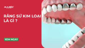 Minh họa răng sứ kim loại là gì