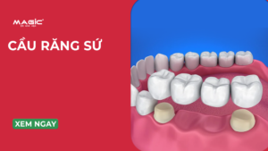5 Phương Pháp Cầu Răng Sứ & Tình Trạng Răng Nên Bắc Cầu Răng Sứ 9