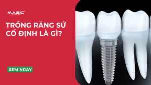 Trồng Răng Sứ Cố Định Là Gì? 3 Phương Pháp Phổ Biến 14
