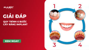 Quy Trình 9 Bước Cấy Răng Implant Chuẩn Nha Khoa 4