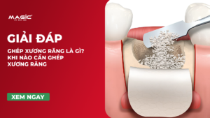 Ghép Xương Răng Là Gì? Khi Nào Cần Ghép Xương Răng 2