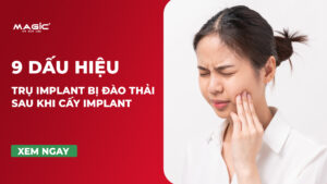 9 Dấu Hiệu Trụ Implant Bị Đào Thải Sau Khi Cấy Implant 11