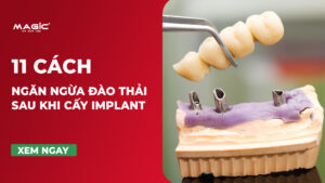 11 Cách Ngăn Ngừa Đào Thải Sau Khi Cấy Implant 12