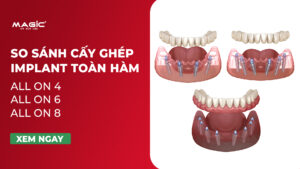 So Sánh Cấy Ghép Implant Toàn Hàm All-on-4, All-on-6, All-on-8 13